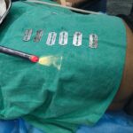 बुजुर्ग ने ब्लेड खाकर की आत्महत्या की कोशिश, सिम्स के डॉक्टरों ने बचाई जान