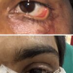 युवक को नई दृष्टि और सामान्य जीवन की ओर लौटने का मिला अवसर स्किन ग्राफ्टिंग से मरीज के पलक का सफल पुनर्निर्माण,